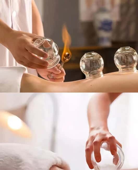 Shanghai: Chinese Medicine Acupuncture and Cupping Session - The Value of a Guided, Authentic Experience